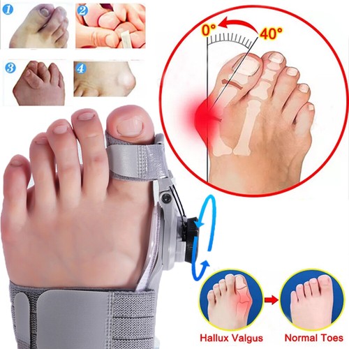 Treatment bunion fix - treatment,