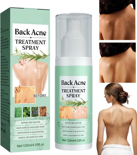 Acne treatment spray for back - acne,