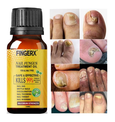 Best fungal nail treatment - nail,