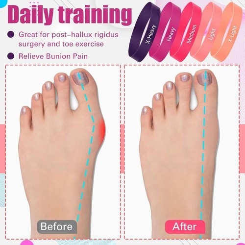 5pcs hallux valgus alignment - 5pcs,