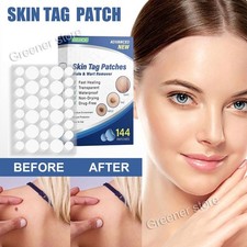 UK 144pcs Kit Skin Tag Remover