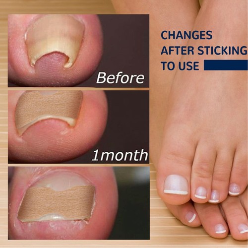 50x ingrown toenail - ingrown,