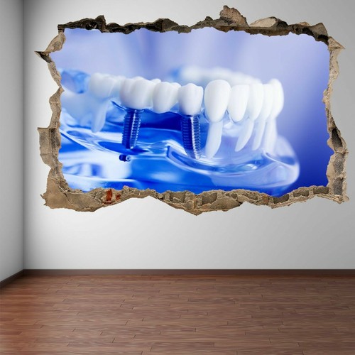 Implant tooth dental - implant, care