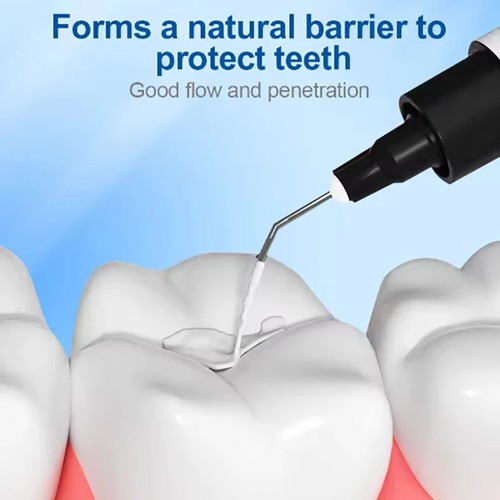 Dental pit fissure - fissure, sealant