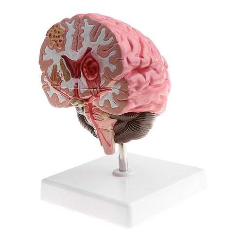 Human diseased brain pathology - diseased,