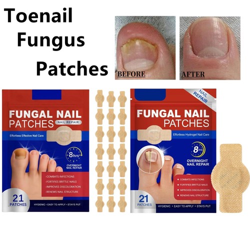 Patches fungal nail - fungal,