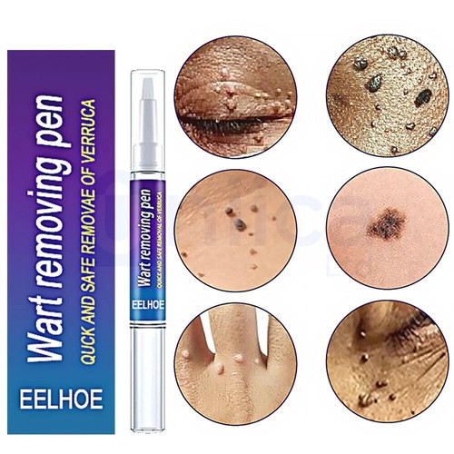 Wart remover pen skin - wart,