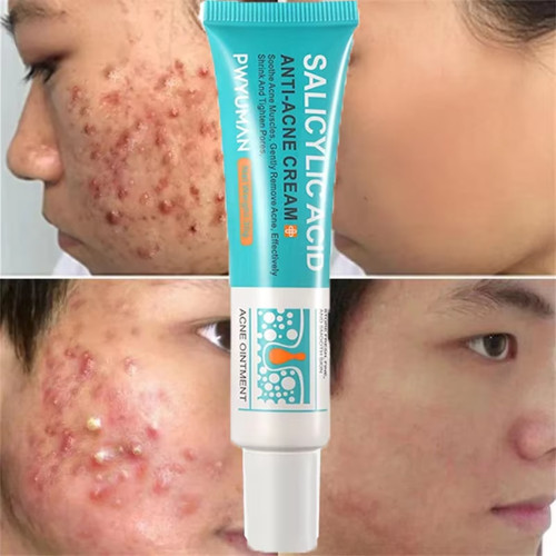 Salicylic acid strong - salicylic,