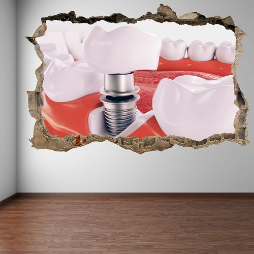 Dental tooth implant wall - dental,