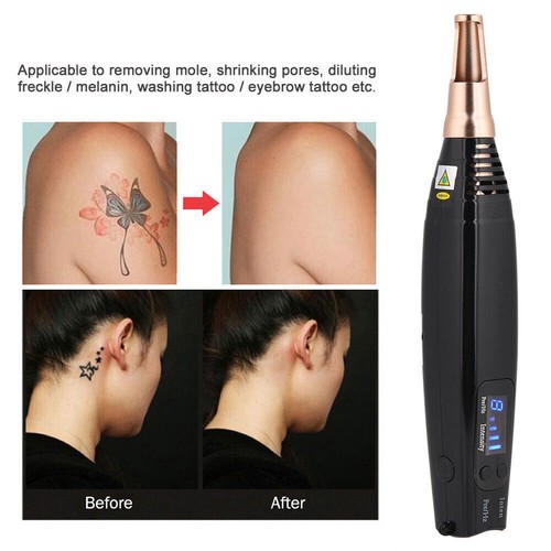 Tattoo laser scar - tattoo, spot