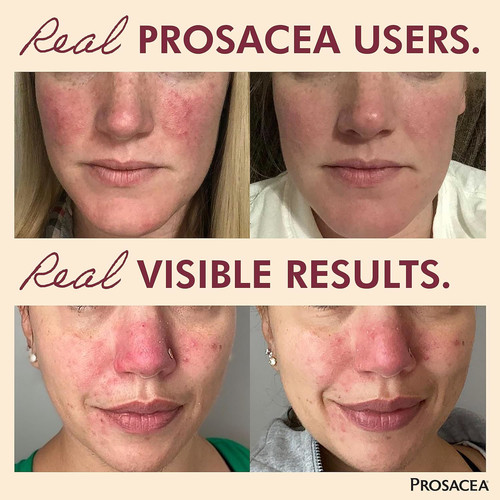 Prosacea controls maskne - controls,