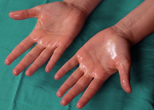 Excessive hand sweating - excessive,