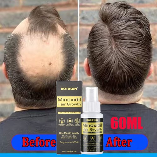 Minoxidil extras strength - minoxidil, 5%