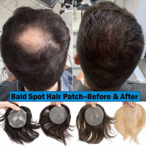 8cm bald spot hair patches - spot,