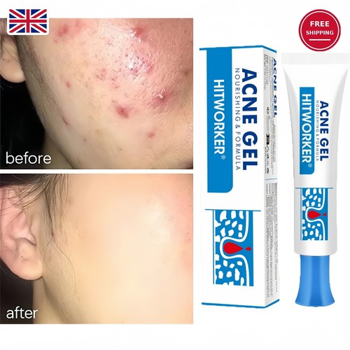 Salicylic acid strong acne - salicylic,