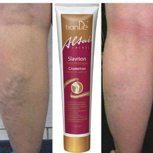Varicose veins legs - varicose, cream
