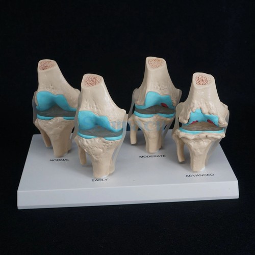 Anatomical human degenerative - human,