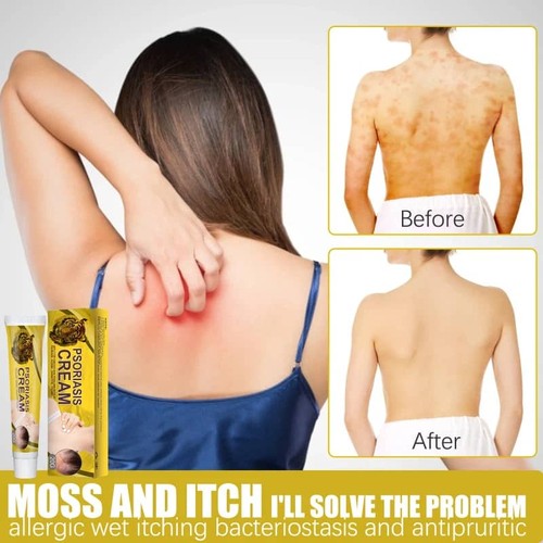 20g psoriasis ointment cream - 20g,