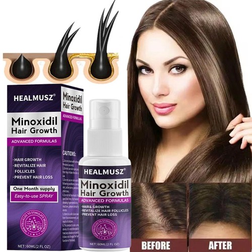 Minoxidil for women - women, hair