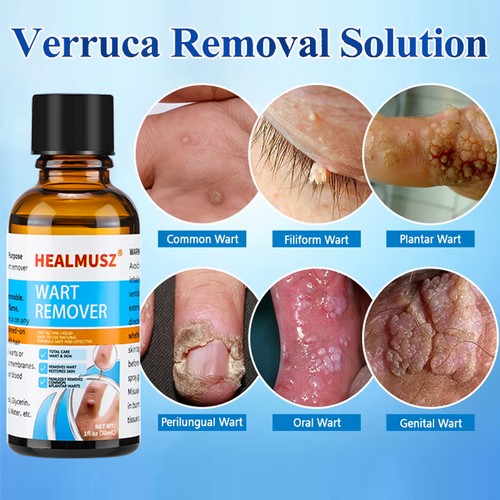 Wart remover liquid 30ml skin - wart,