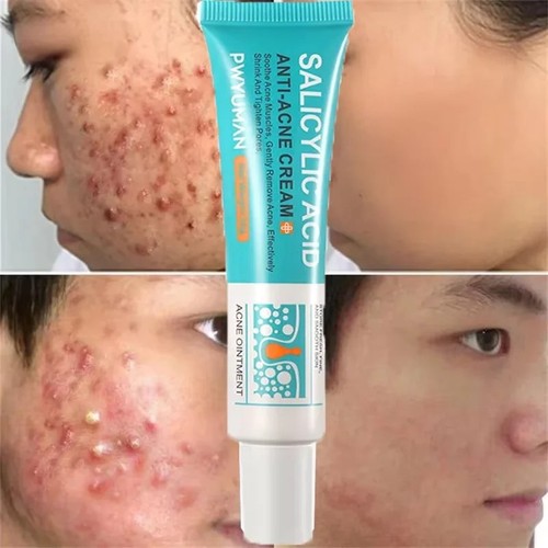 Salicylic acid strong acne - strong,