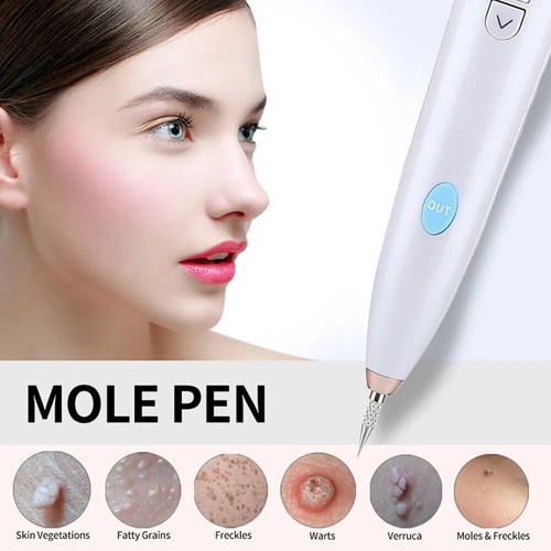 Laser plasma pen mole removal - laser,