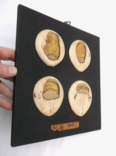 Rare antique anatomical - a,