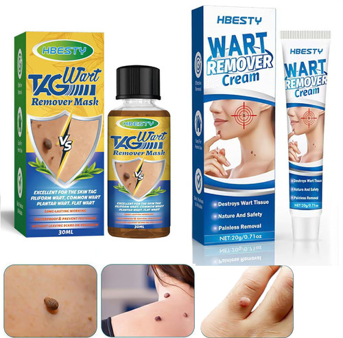 Wart removal body mole - wart, warts