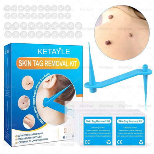 Rubber bands skin tag remover - rubber,