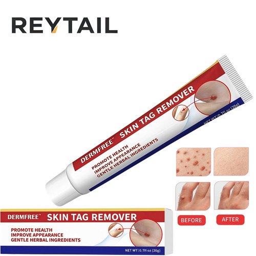 Strong skin tag remover cream - skin,