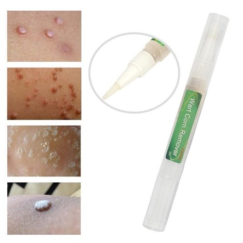 Skin tag removal treatment - tag,