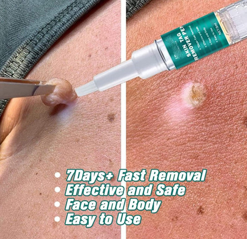 Days wart remover - 7, pen