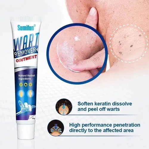 Warts remover ointment - remover,