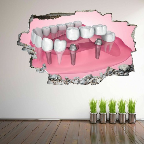 Dental tooth implant wall - implant,