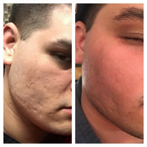 Microdermabrasion crystals - microdermabrasion,