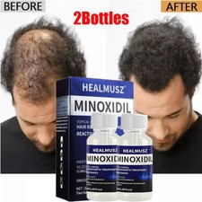 2 Months Minoxidil 5% Extra