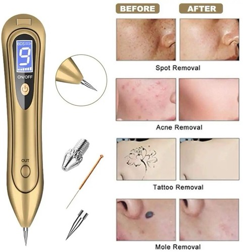 Lcd laser plasma skin tag - laser,