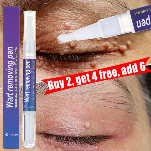 Wart remover pen - wart, skin