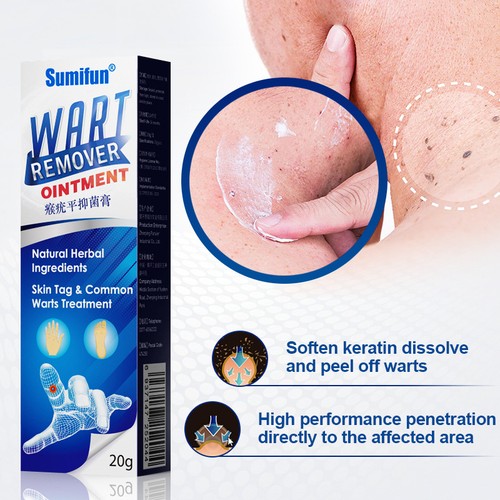 Wart removal treatment cream - treatment,