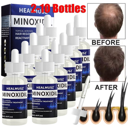 Minoxidil topical solution - minoxidil,