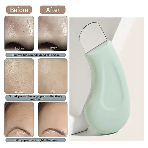 Stainless steel blackhead - steel,