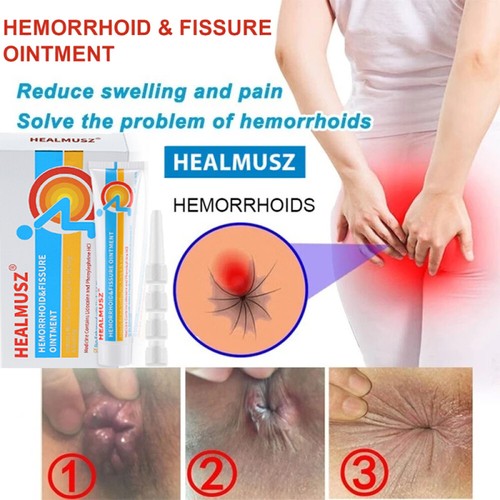 Hemorrhoids ointment cream - hemorrhoids,