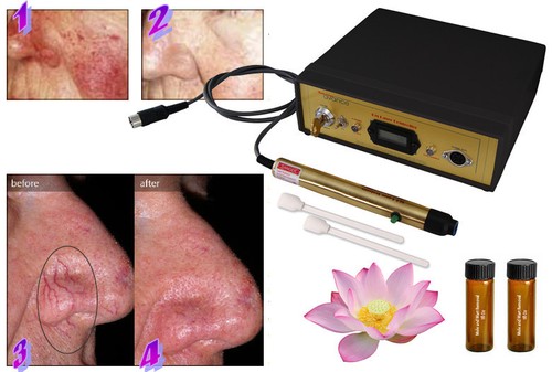 Laser spider vein capillary - spider,