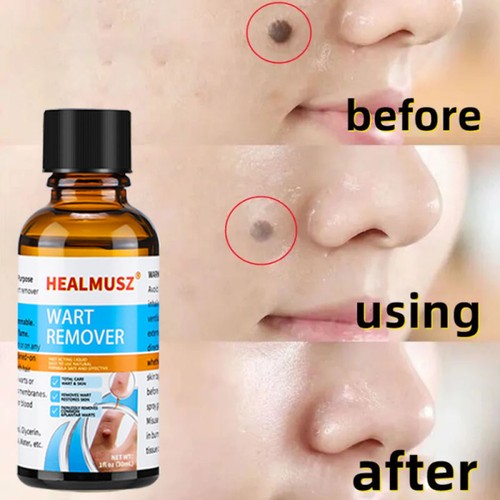 Wart remover fast - wart, and
