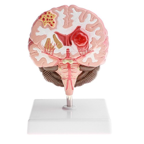 Human diseased brain pathology - diseased,