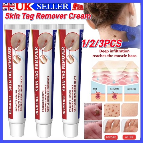 Strong skin tag - tag, remover