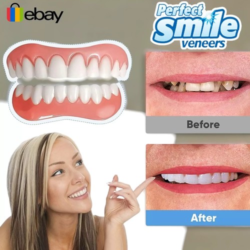 Veneers top bottom false - bottom,