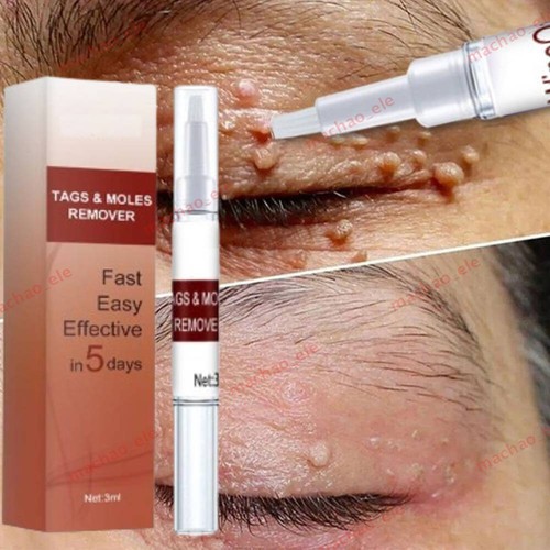 Skin tags moles removal - &,